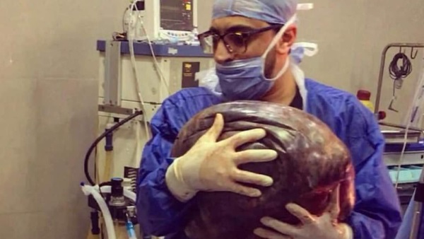 استئصال واحدًا من أكبر الأورام في العالم على يد طبيب مصري