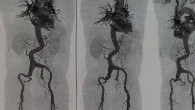 جراحه معقده لتمدد و تضخم بالشريان الاروطي البطيني