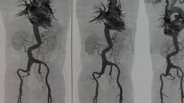 جراحه معقده لتمدد و تضخم بالشريان الاروطي البطيني