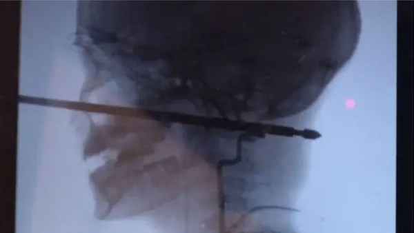 طفل يهشم رأس ابن خاله 