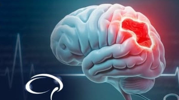  السكتة الدماغية