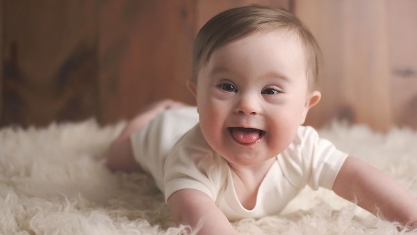 أطفال المصابين بمتلازمة داون