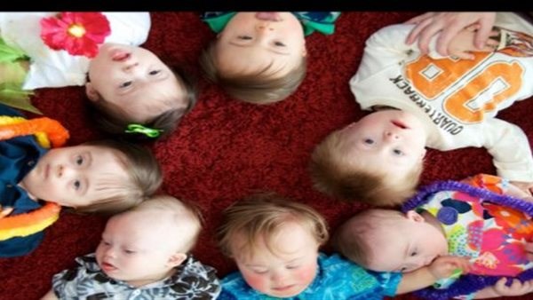 الأطفال ذوو متلازمة داون