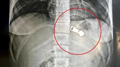 استخراج جسم معدني من معدة طفلة