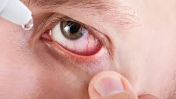 الرمد الحبيبي 