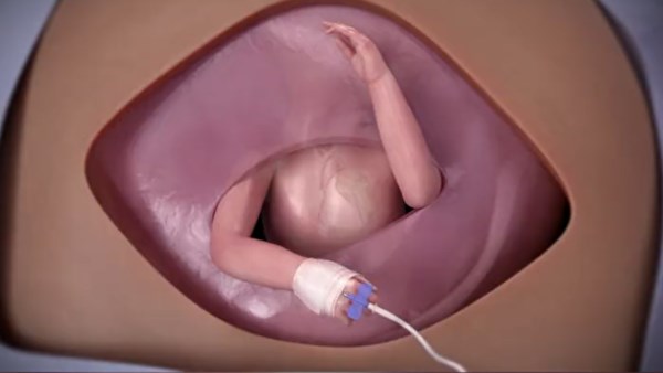 جراحات الأجنة داخل الرحم 