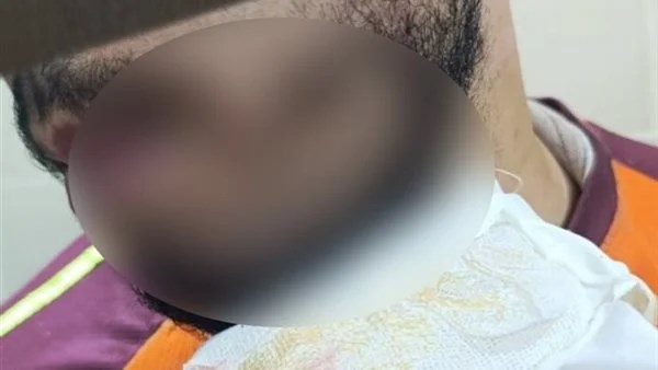 اعتداء بسلاح أبيض على مندوب توصيل في حدائق القبة وإصابته بـ36 غرزة في الوجه