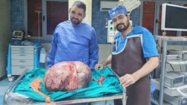 استئصال ورم مبيضي نادر يزن 24 كيلو جرامًا