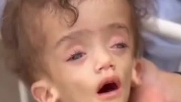  تحول لهيكل عظمي ..رضيع فلسطيني في غزة يواجه سوء التغذية الحاد وسط معاناة أسرته لتوفير العلاج