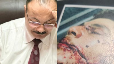 بعد التصالح بـ4 شهور.. الاعتداء على يحيى بـ72 غرزة في أبشواي